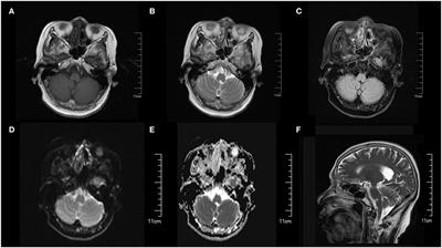 Hashimoto's encephalopathy with cerebellar ataxia as the main symptom: A case report and literature review